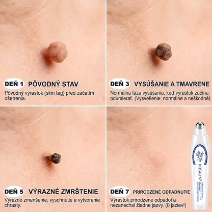 𝑶𝒇𝒊𝒄𝒊á𝒍𝒏𝒚 𝒐𝒃𝒄𝒉𝒐𝒅 ✅️ | 𝐇𝐈𝐒𝐊𝐈𝐍® 7-𝒅ň𝒐𝒗ý 𝒑𝒓í𝒑𝒓𝒂𝒗𝒐𝒌 𝒏𝒂 𝒐𝒅𝒔𝒕𝒓á𝒏𝒆𝒏𝒊𝒆 𝒌𝒐ž𝒏ý𝒄𝒉 𝒗ý𝒓𝒂𝒔𝒕𝒌𝒐𝒗 𝒂 𝒑𝒊𝒈𝒎𝒆𝒏𝒕𝒐𝒗ý𝒄𝒉 š𝒌𝒗ŕ𝒏👩‍⚕️ (𝒃𝒆𝒛 𝒃𝒐𝒍𝒆𝒔𝒕𝒊, 𝒃𝒆𝒛 𝒋𝒂𝒛𝒊𝒆𝒗, 𝒑𝒓𝒆𝒔𝒏ý 𝒓𝒐𝒍𝒍-𝒐𝒏 𝒂𝒑𝒍𝒊𝒌á𝒕𝒐𝒓) 🔥